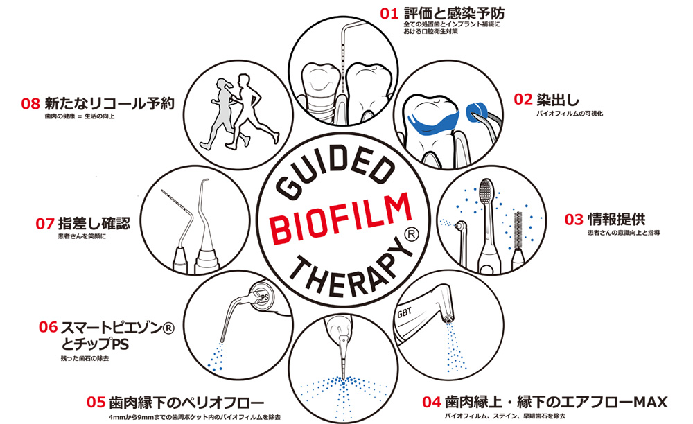 01 評価と感染予防 全ての処置歯とインプラント補綴における口腔衛生対策
02 染出し バイオフィルムの可視化
03 情報提供 患者さんの意識向上と指導
04 歯肉縁上・縁下のエアフローMAX
05 歯肉縁下のペリオフロー
06 スマートピエゾン®とチップPS
07 指差し確認患者さんを笑顔に
08 新たなリコール予約歯肉の健康