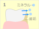 フッ素塗布