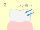 フッ素塗布